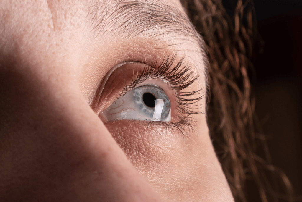Close-up of woman's eye with keratoconus